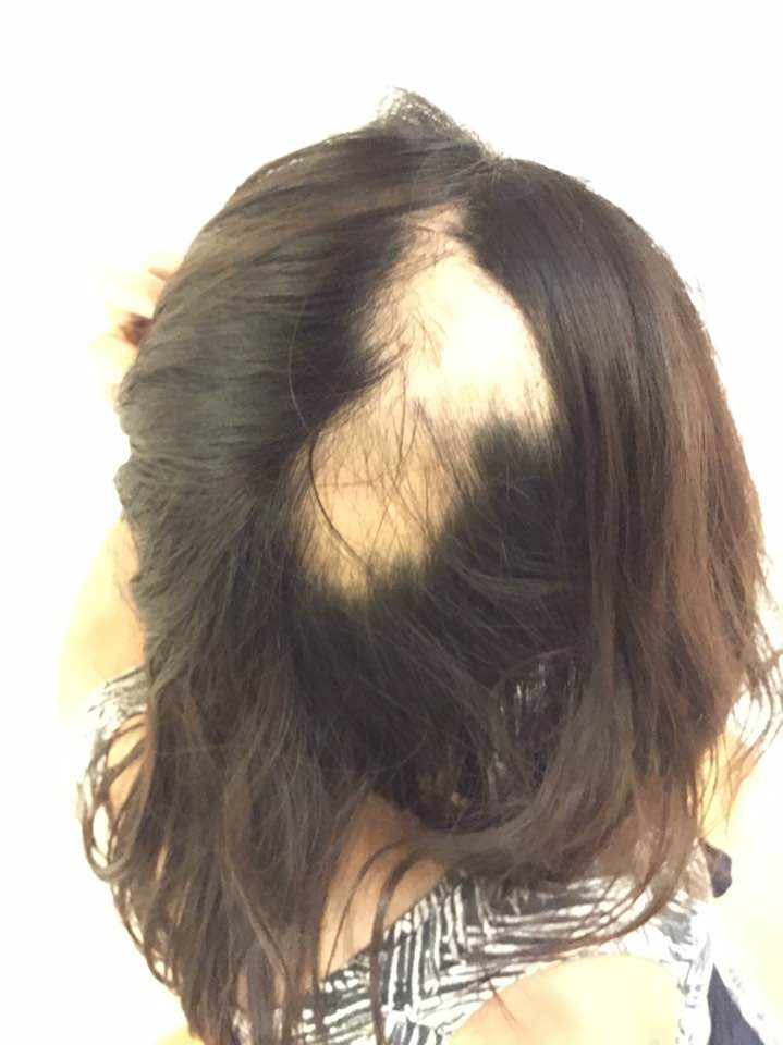 私の円形脱毛症について グロい髪の毛写真あり 海外子育てブログ